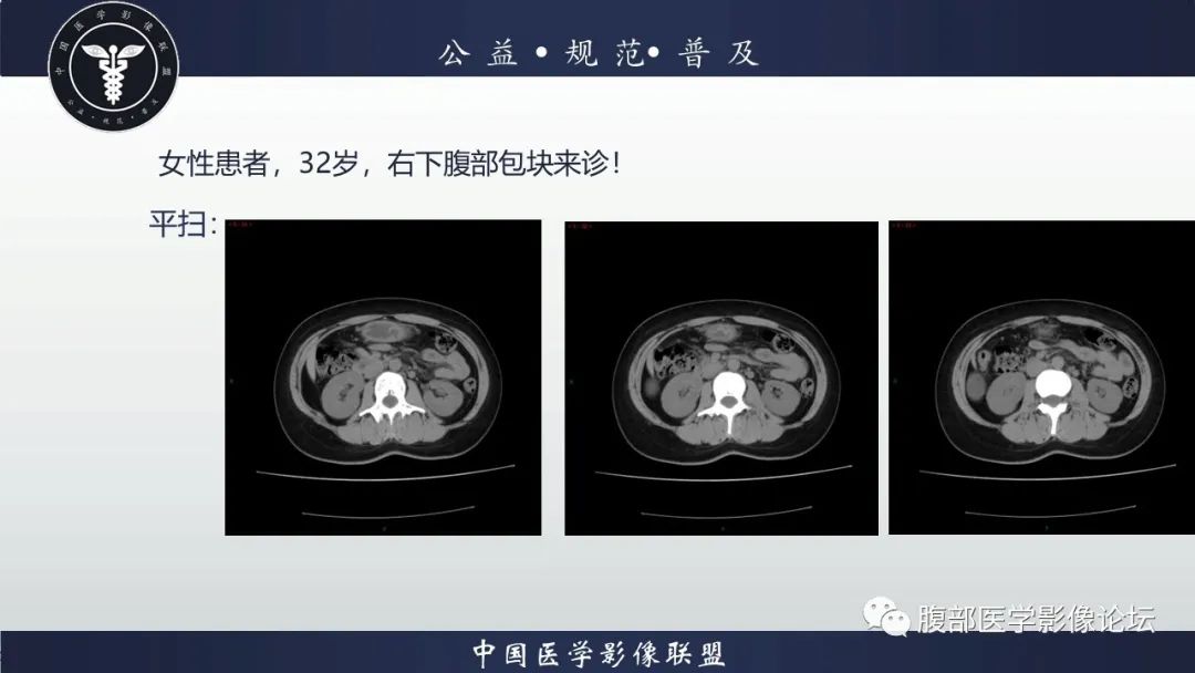 影像PPT - 【病例】腹膜后周围神经鞘瘤1例CT影像-2