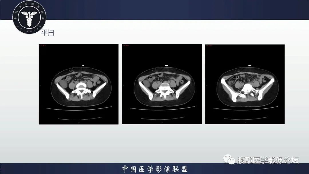 影像PPT - 【病例】腹膜后周围神经鞘瘤1例CT影像-5