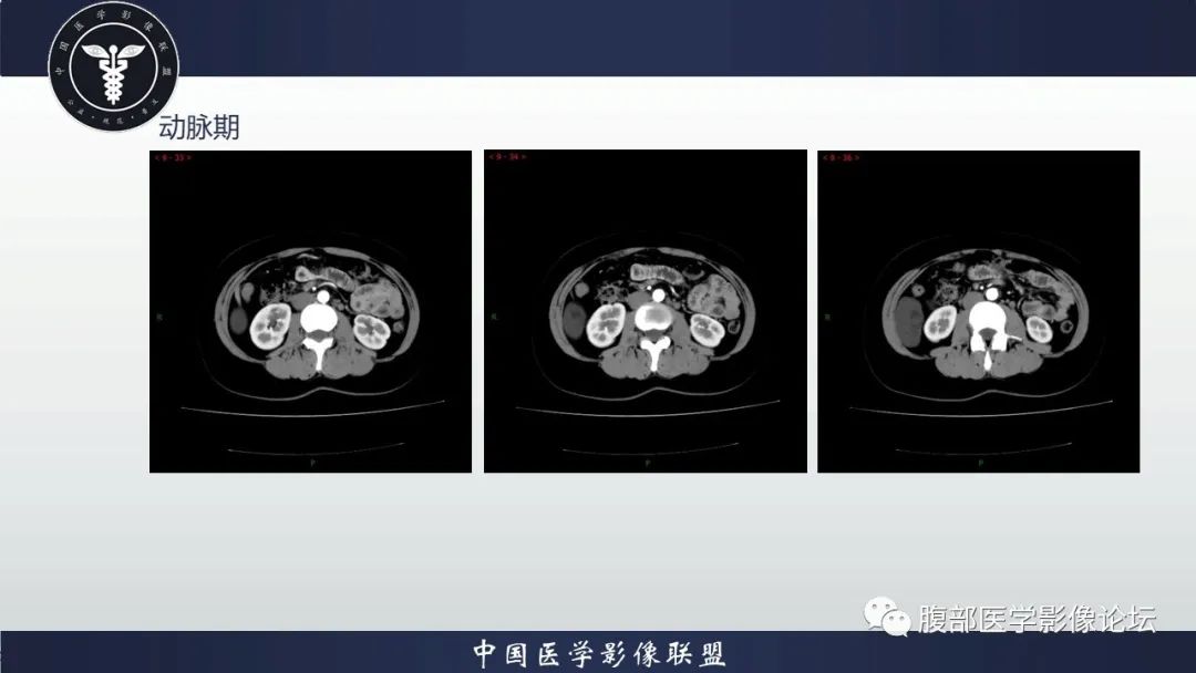 影像PPT - 【病例】腹膜后周围神经鞘瘤1例CT影像-6