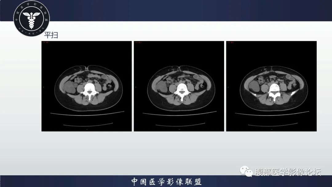 影像PPT - 【病例】腹膜后周围神经鞘瘤1例CT影像-4