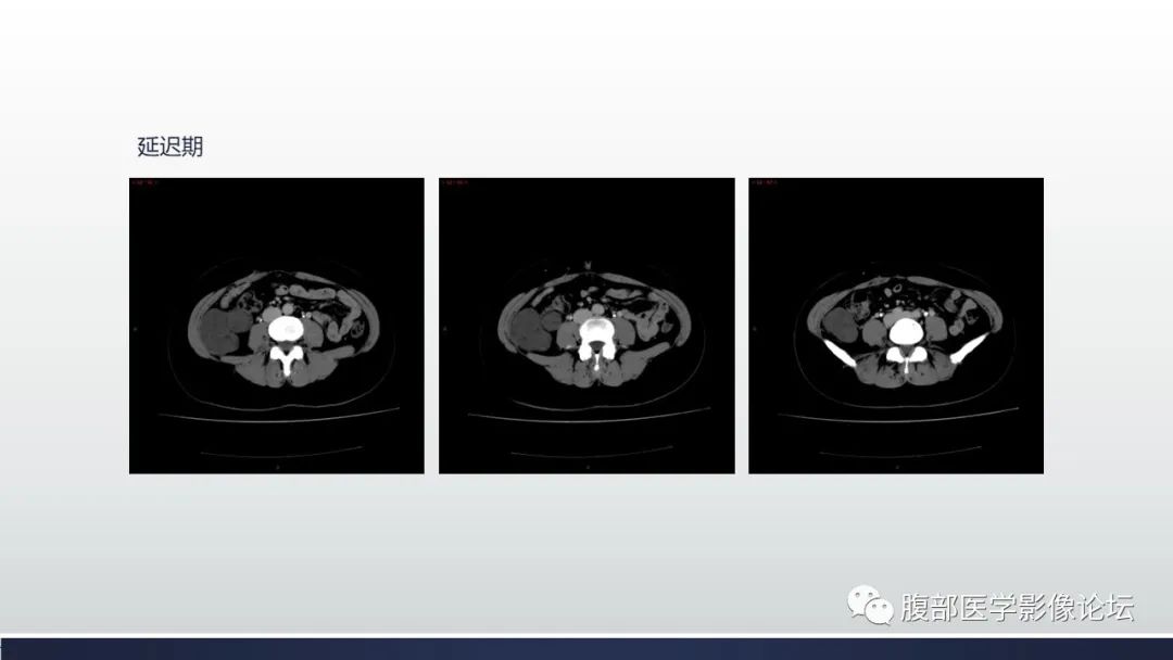 影像PPT - 【病例】腹膜后周围神经鞘瘤1例CT影像-15