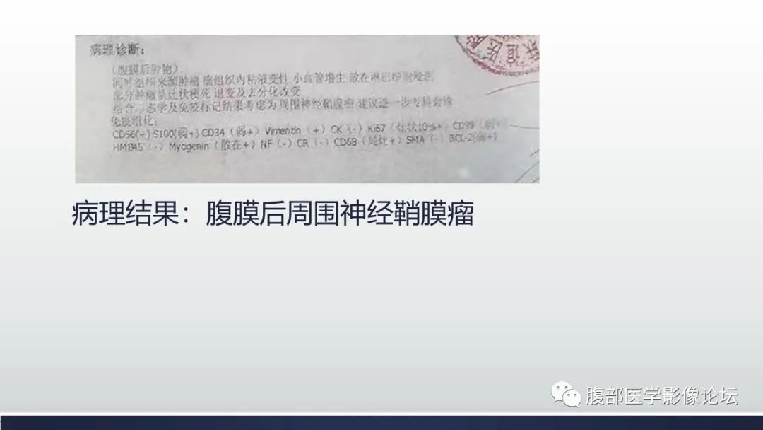 影像PPT - 【病例】腹膜后周围神经鞘瘤1例CT影像-16