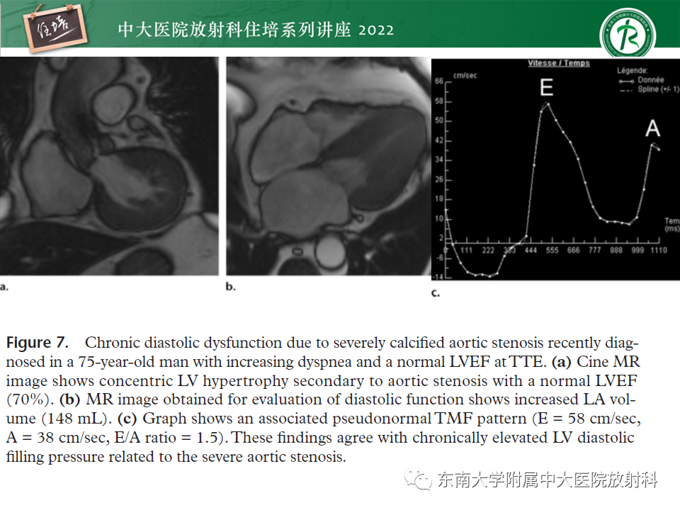 影像PPT - 【PPT】心脏磁共振评估左室舒张功能-23