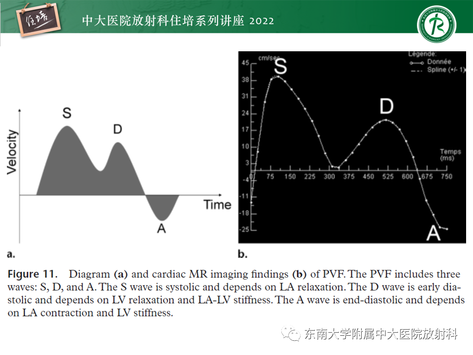 影像PPT - 【PPT】心脏磁共振评估左室舒张功能-30