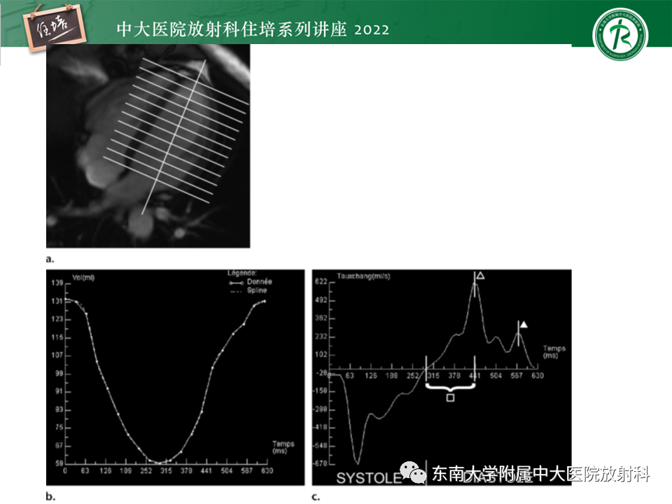 影像PPT - 【PPT】心脏磁共振评估左室舒张功能-34