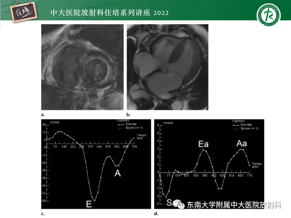 影像PPT - 【PPT】心脏磁共振评估左室舒张功能-38