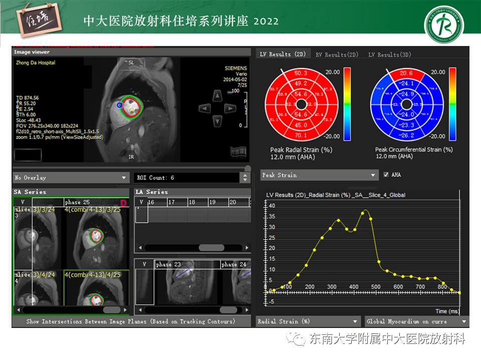 影像PPT - 【PPT】心脏磁共振评估左室舒张功能-43