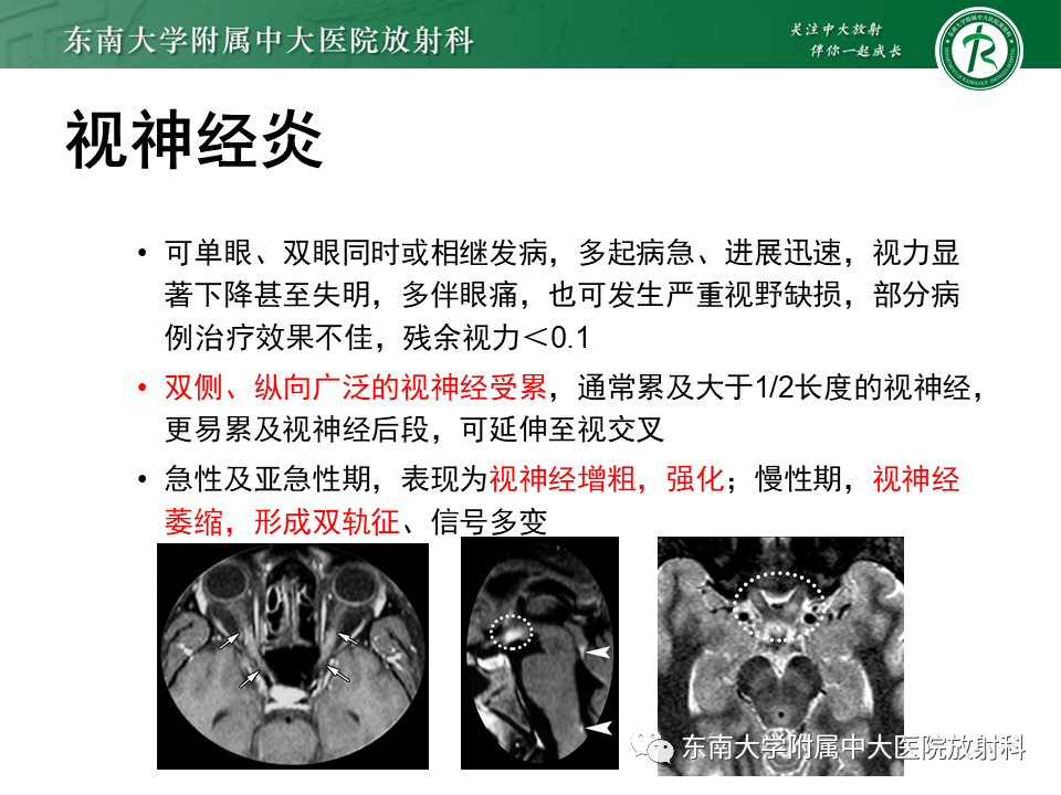 影像PPT - 【PPT】视神经脊髓炎谱系疾病-9 影像PPT - 【PPT】视神经脊髓炎谱系疾病-9