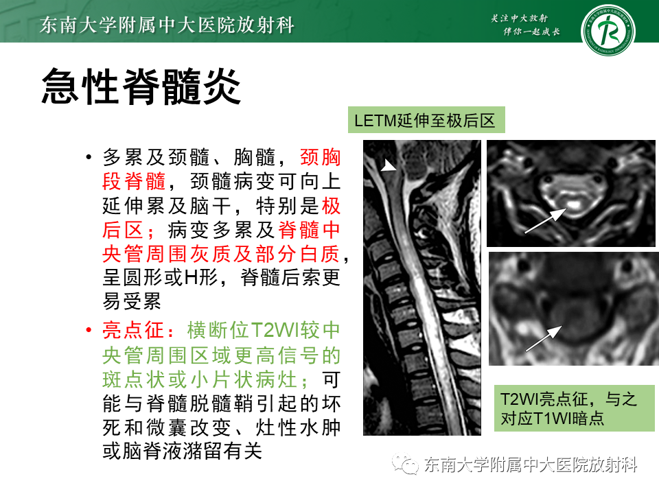 影像PPT - 【PPT】视神经脊髓炎谱系疾病-11 影像PPT - 【PPT】视神经脊髓炎谱系疾病-11