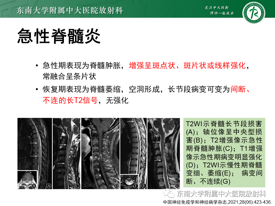 影像PPT - 【PPT】视神经脊髓炎谱系疾病-12 影像PPT - 【PPT】视神经脊髓炎谱系疾病-12