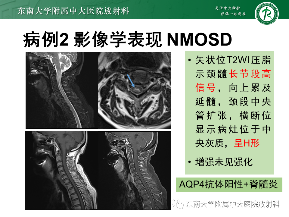 影像PPT - 【PPT】视神经脊髓炎谱系疾病-14 影像PPT - 【PPT】视神经脊髓炎谱系疾病-14