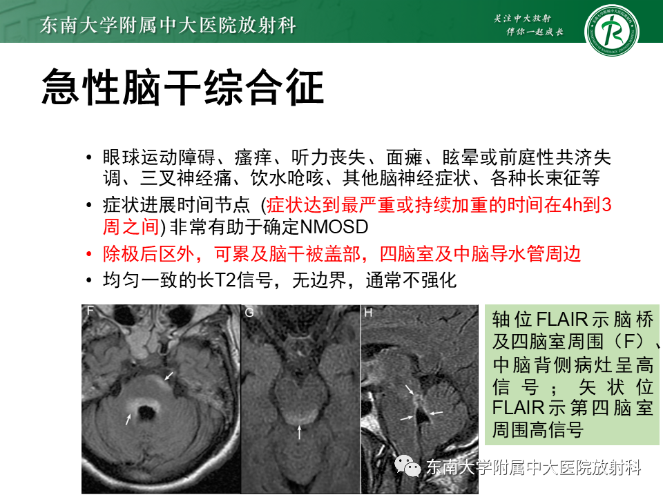 影像PPT - 【PPT】视神经脊髓炎谱系疾病-16 影像PPT - 【PPT】视神经脊髓炎谱系疾病-16