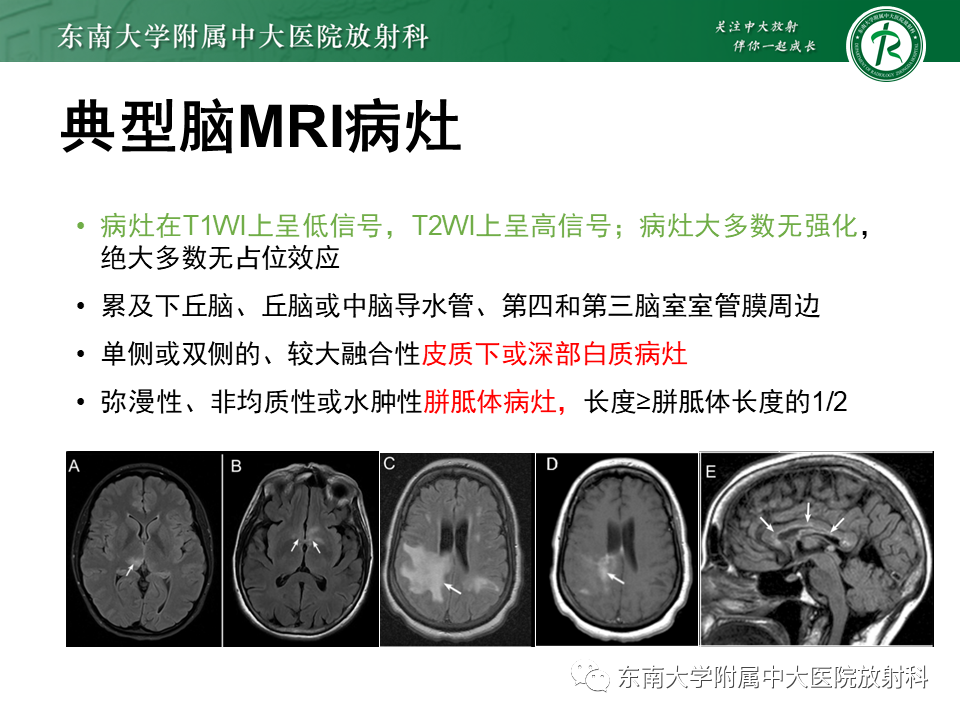 影像PPT - 【PPT】视神经脊髓炎谱系疾病-17 影像PPT - 【PPT】视神经脊髓炎谱系疾病-17