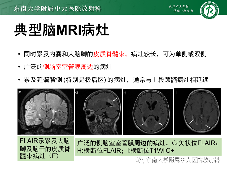 影像PPT - 【PPT】视神经脊髓炎谱系疾病-18 影像PPT - 【PPT】视神经脊髓炎谱系疾病-18