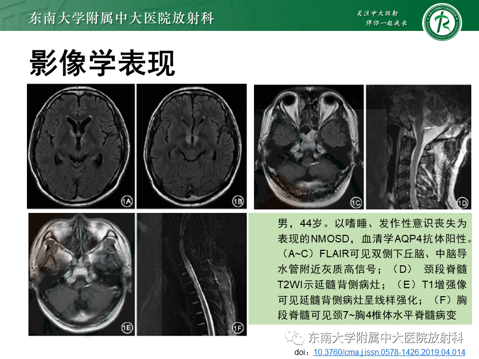 影像PPT - 【PPT】视神经脊髓炎谱系疾病-20 影像PPT - 【PPT】视神经脊髓炎谱系疾病-20