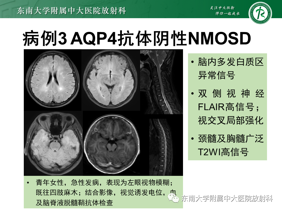 影像PPT - 【PPT】视神经脊髓炎谱系疾病-23 影像PPT - 【PPT】视神经脊髓炎谱系疾病-23