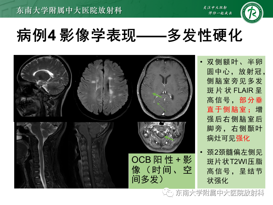 影像PPT - 【PPT】视神经脊髓炎谱系疾病-28 影像PPT - 【PPT】视神经脊髓炎谱系疾病-28