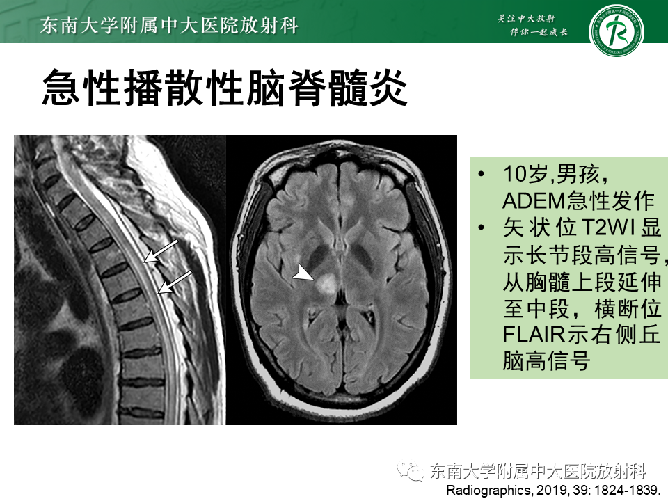 影像PPT - 【PPT】视神经脊髓炎谱系疾病-31 影像PPT - 【PPT】视神经脊髓炎谱系疾病-31