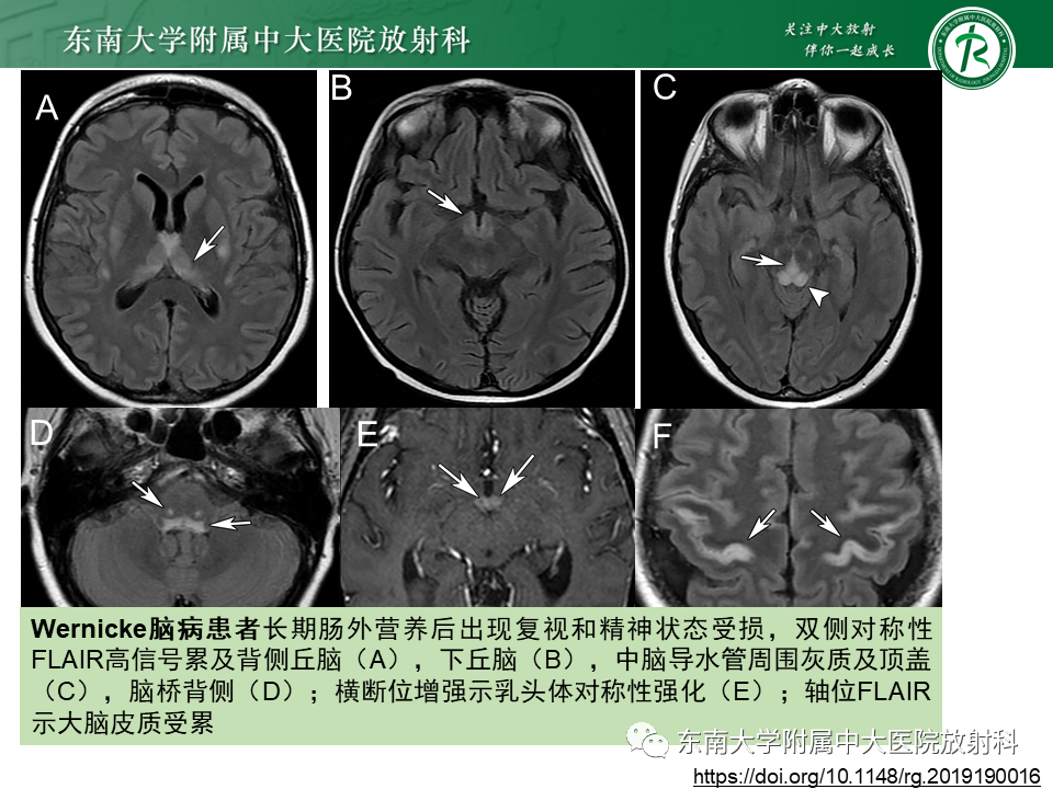 影像PPT - 【PPT】视神经脊髓炎谱系疾病-33 影像PPT - 【PPT】视神经脊髓炎谱系疾病-33