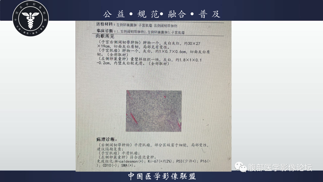 影像PPT - 【病例】巨大阔韧带平滑肌瘤1例CT影像表现-11