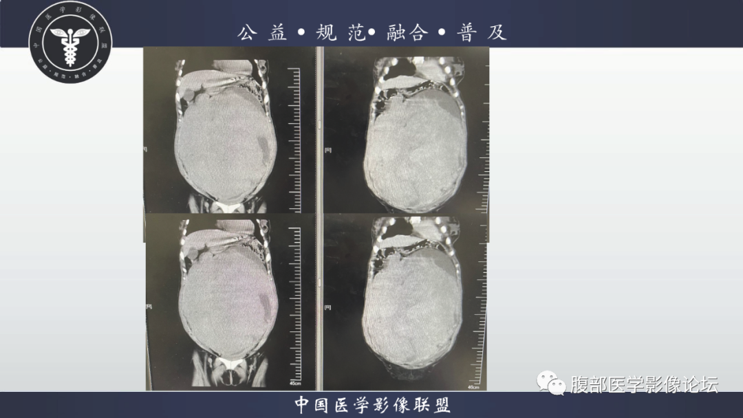 影像PPT - 【病例】巨大阔韧带平滑肌瘤1例CT影像表现-9