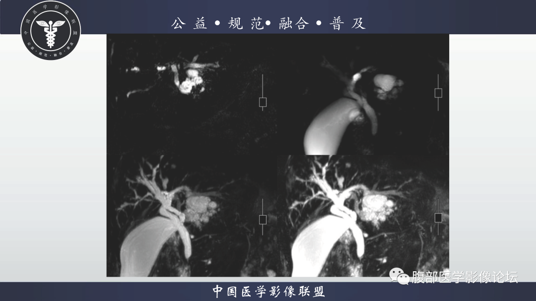 影像PPT - 【病例】巨大阔韧带平滑肌瘤1例CT影像表现-21