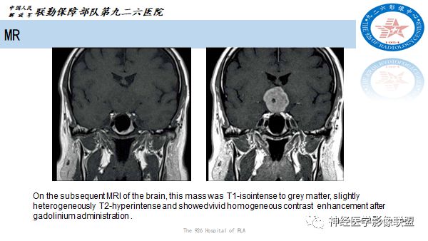 影像PPT - 【病例】八字水肿征—脊索样胶质瘤1例影像表现分析-2 影像PPT - 【病例】八字水肿征—脊索样胶质瘤1例影像表现分析-2