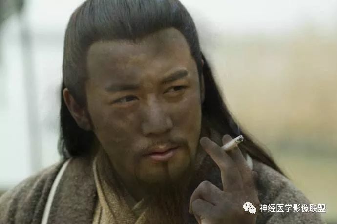 影像PPT - 【病例】八字水肿征—脊索样胶质瘤1例影像表现分析-5 影像PPT - 【病例】八字水肿征—脊索样胶质瘤1例影像表现分析-5