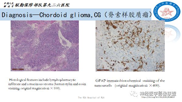 影像PPT - 【病例】八字水肿征—脊索样胶质瘤1例影像表现分析-7 影像PPT - 【病例】八字水肿征—脊索样胶质瘤1例影像表现分析-7