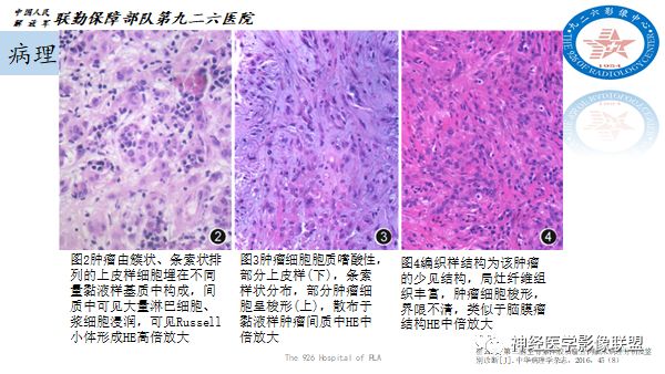 影像PPT - 【病例】八字水肿征—脊索样胶质瘤1例影像表现分析-9 影像PPT - 【病例】八字水肿征—脊索样胶质瘤1例影像表现分析-9