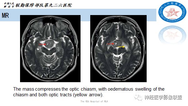 影像PPT - 【病例】八字水肿征—脊索样胶质瘤1例影像表现分析-3 影像PPT - 【病例】八字水肿征—脊索样胶质瘤1例影像表现分析-3