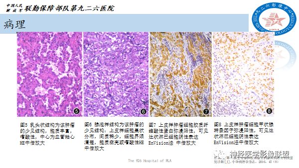 影像PPT - 【病例】八字水肿征—脊索样胶质瘤1例影像表现分析-10 影像PPT - 【病例】八字水肿征—脊索样胶质瘤1例影像表现分析-10