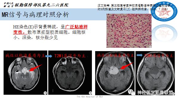 影像PPT - 【病例】八字水肿征—脊索样胶质瘤1例影像表现分析-13 影像PPT - 【病例】八字水肿征—脊索样胶质瘤1例影像表现分析-13