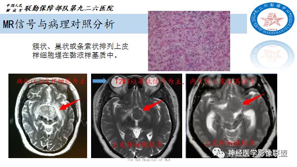 影像PPT - 【病例】八字水肿征—脊索样胶质瘤1例影像表现分析-14 影像PPT - 【病例】八字水肿征—脊索样胶质瘤1例影像表现分析-14