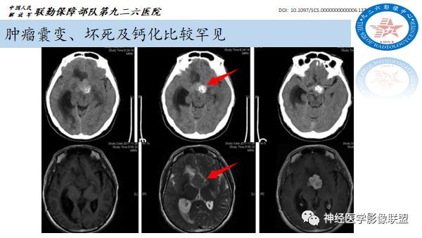 影像PPT - 【病例】八字水肿征—脊索样胶质瘤1例影像表现分析-16 影像PPT - 【病例】八字水肿征—脊索样胶质瘤1例影像表现分析-16