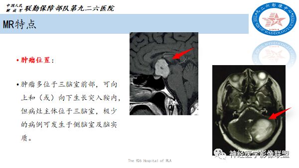 影像PPT - 【病例】八字水肿征—脊索样胶质瘤1例影像表现分析-11 影像PPT - 【病例】八字水肿征—脊索样胶质瘤1例影像表现分析-11