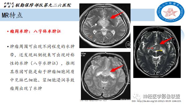 影像PPT - 【病例】八字水肿征—脊索样胶质瘤1例影像表现分析-18 影像PPT - 【病例】八字水肿征—脊索样胶质瘤1例影像表现分析-18