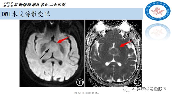影像PPT - 【病例】八字水肿征—脊索样胶质瘤1例影像表现分析-15 影像PPT - 【病例】八字水肿征—脊索样胶质瘤1例影像表现分析-15