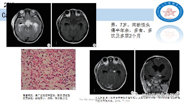 影像PPT - 【病例】八字水肿征—脊索样胶质瘤1例影像表现分析-20 影像PPT - 【病例】八字水肿征—脊索样胶质瘤1例影像表现分析-20