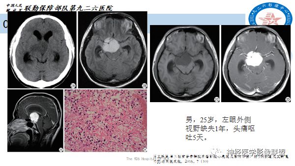 影像PPT - 【病例】八字水肿征—脊索样胶质瘤1例影像表现分析-21 影像PPT - 【病例】八字水肿征—脊索样胶质瘤1例影像表现分析-21