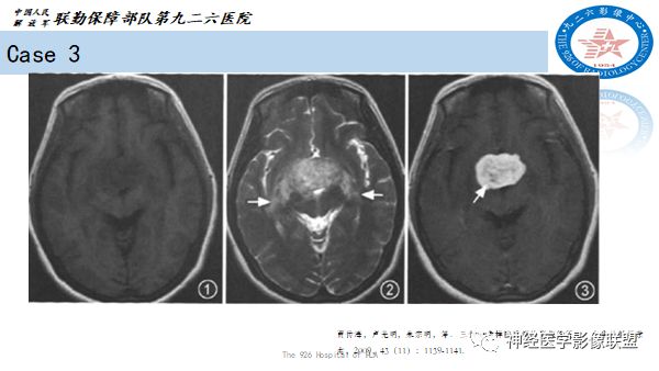 影像PPT - 【病例】八字水肿征—脊索样胶质瘤1例影像表现分析-22 影像PPT - 【病例】八字水肿征—脊索样胶质瘤1例影像表现分析-22