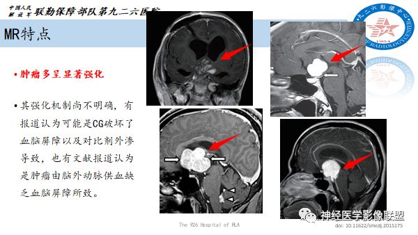 影像PPT - 【病例】八字水肿征—脊索样胶质瘤1例影像表现分析-17 影像PPT - 【病例】八字水肿征—脊索样胶质瘤1例影像表现分析-17