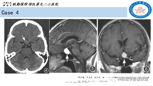 影像PPT - 【病例】八字水肿征—脊索样胶质瘤1例影像表现分析-23 影像PPT - 【病例】八字水肿征—脊索样胶质瘤1例影像表现分析-23