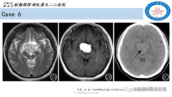 影像PPT - 【病例】八字水肿征—脊索样胶质瘤1例影像表现分析-25 影像PPT - 【病例】八字水肿征—脊索样胶质瘤1例影像表现分析-25