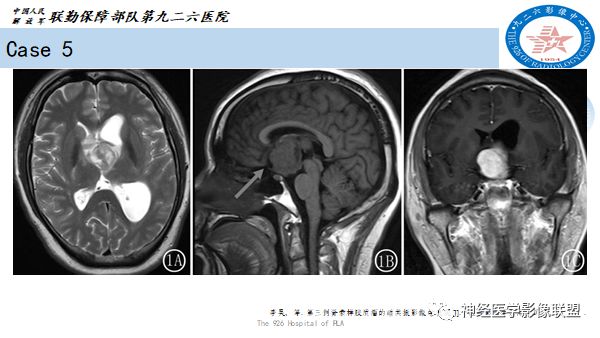 影像PPT - 【病例】八字水肿征—脊索样胶质瘤1例影像表现分析-24 影像PPT - 【病例】八字水肿征—脊索样胶质瘤1例影像表现分析-24