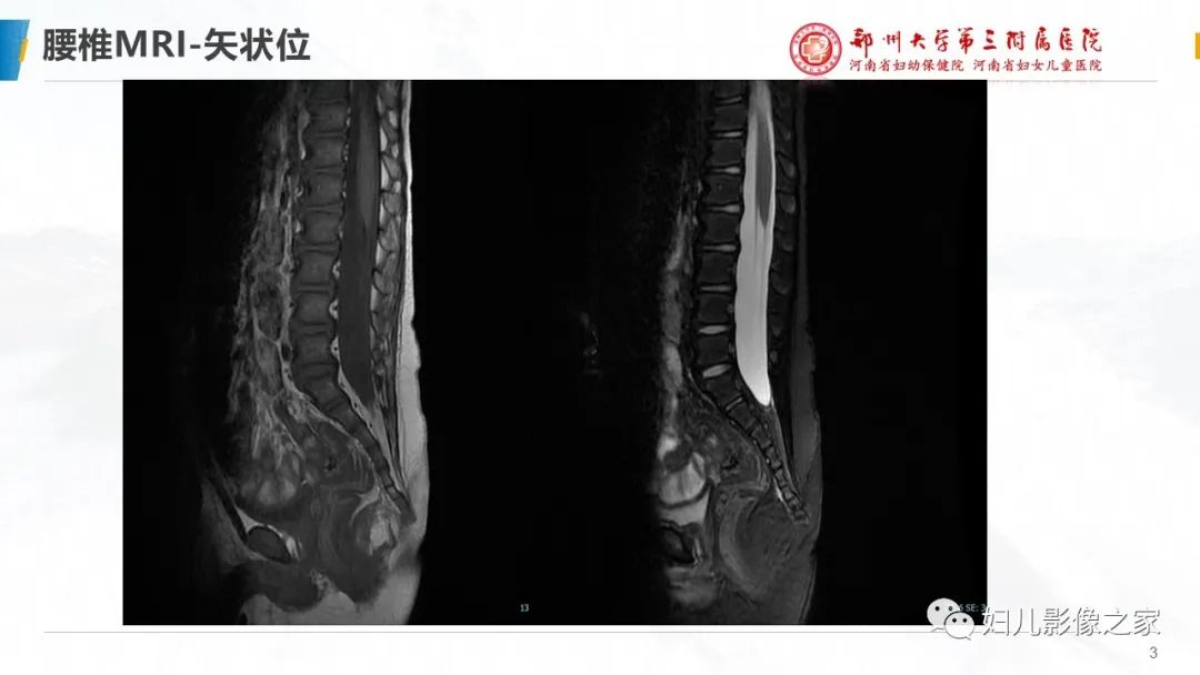 影像PPT - 【PPT】Kabuki综合征的影像诊断-3