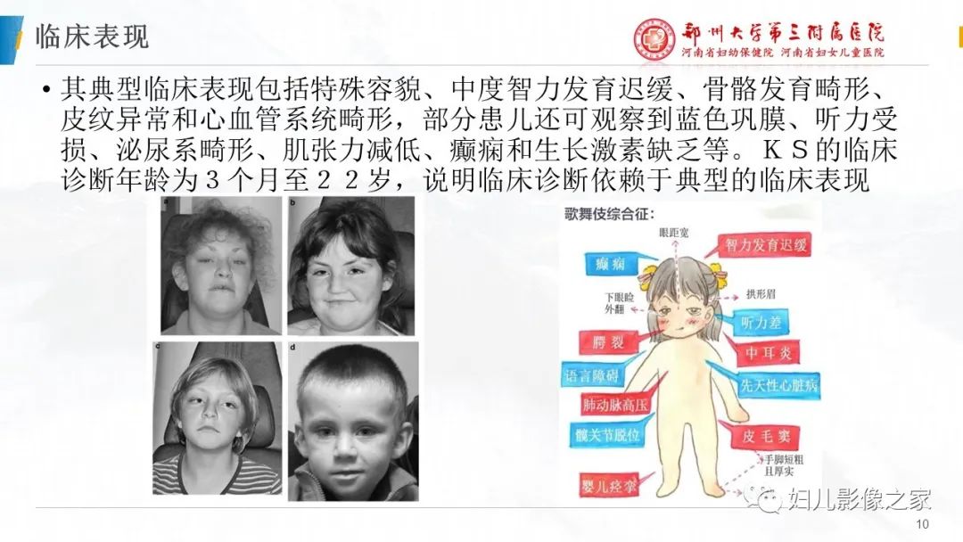 影像PPT - 【PPT】Kabuki综合征的影像诊断-10