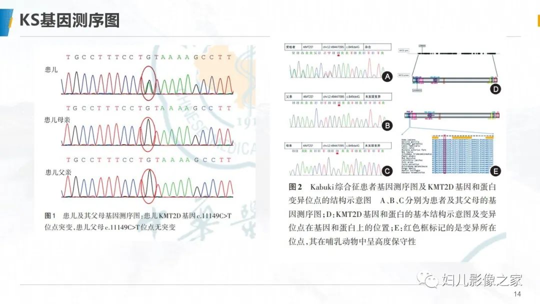 影像PPT - 【PPT】Kabuki综合征的影像诊断-14