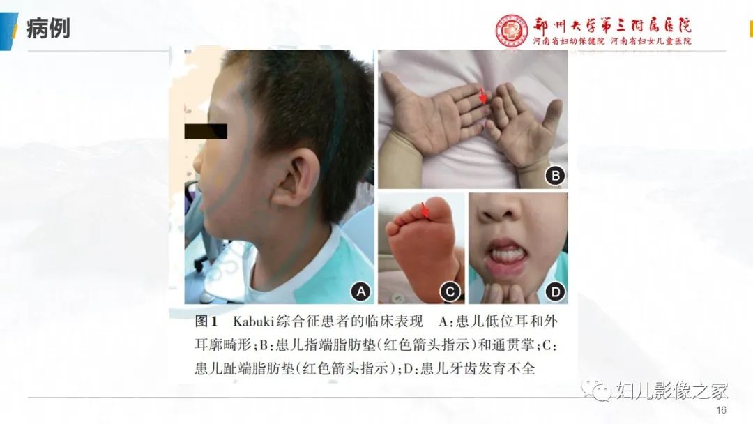 影像PPT - 【PPT】Kabuki综合征的影像诊断-16