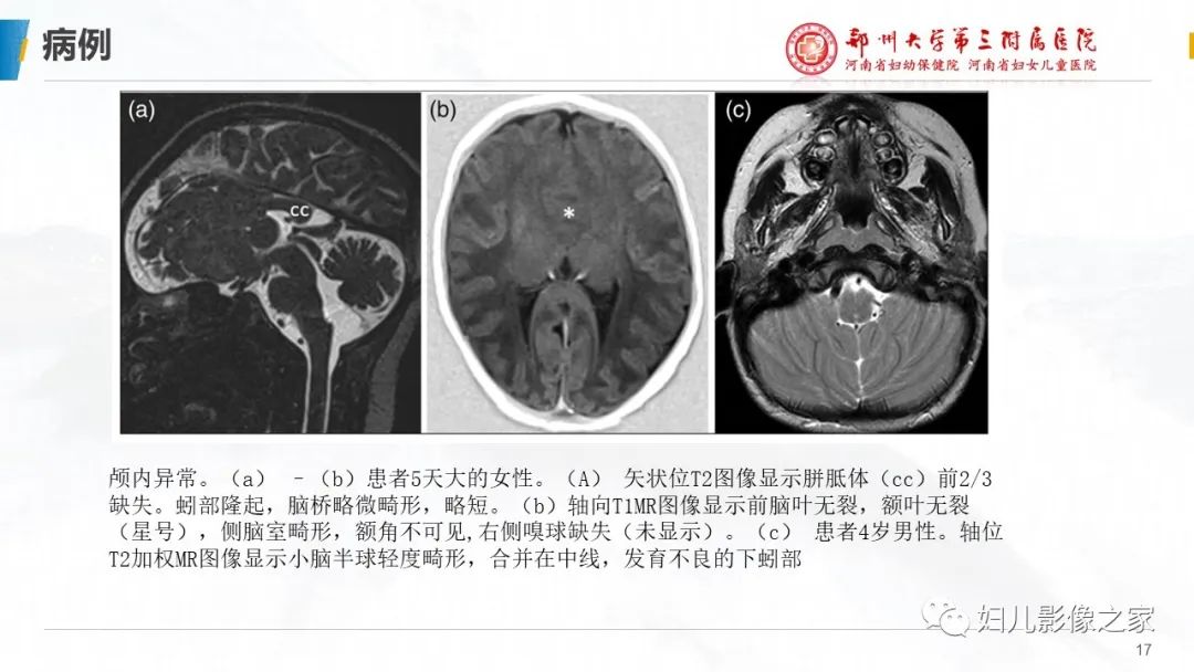 影像PPT - 【PPT】Kabuki综合征的影像诊断-17